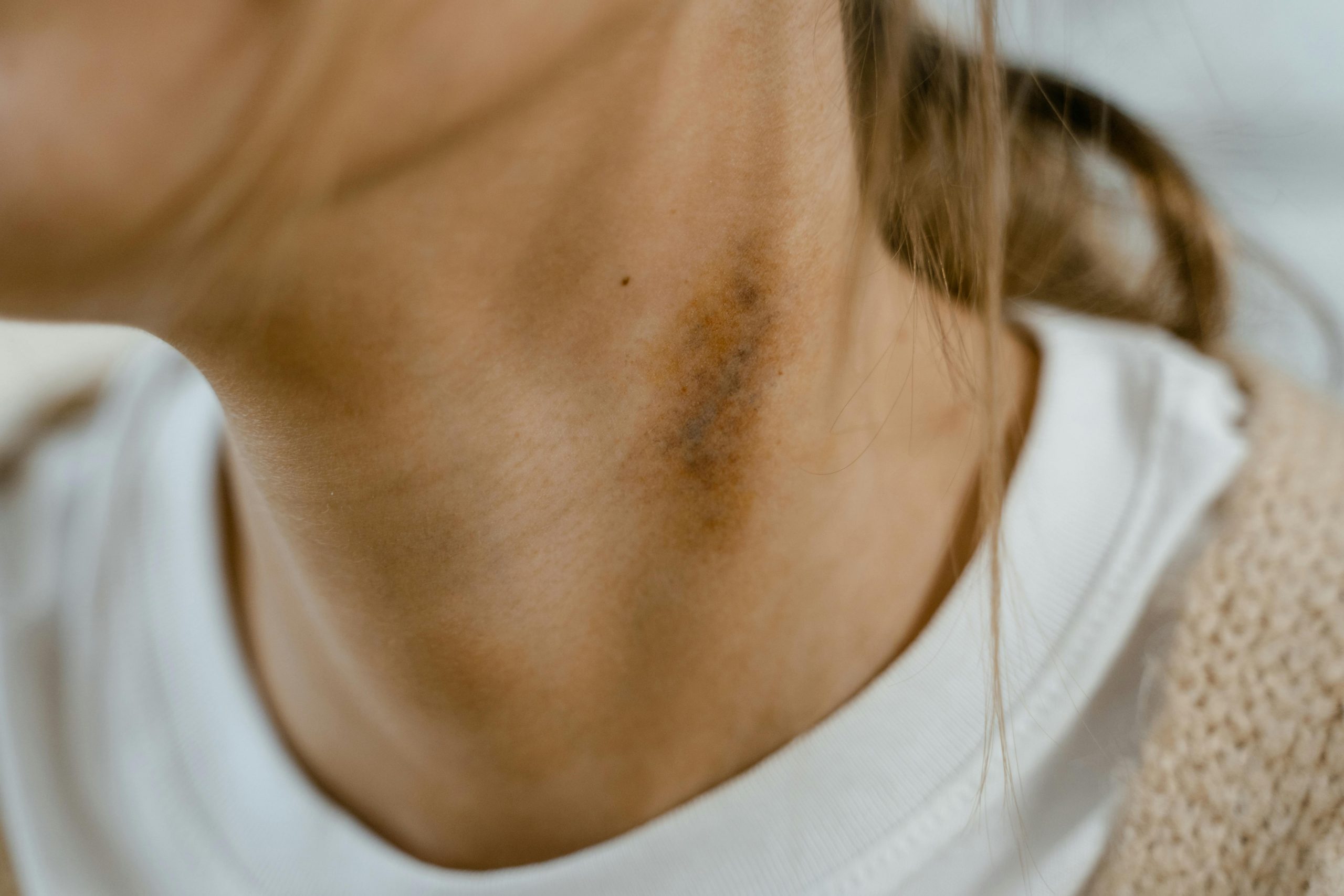 close-up of a bruise on a woman's neck, suggesting physical abuse